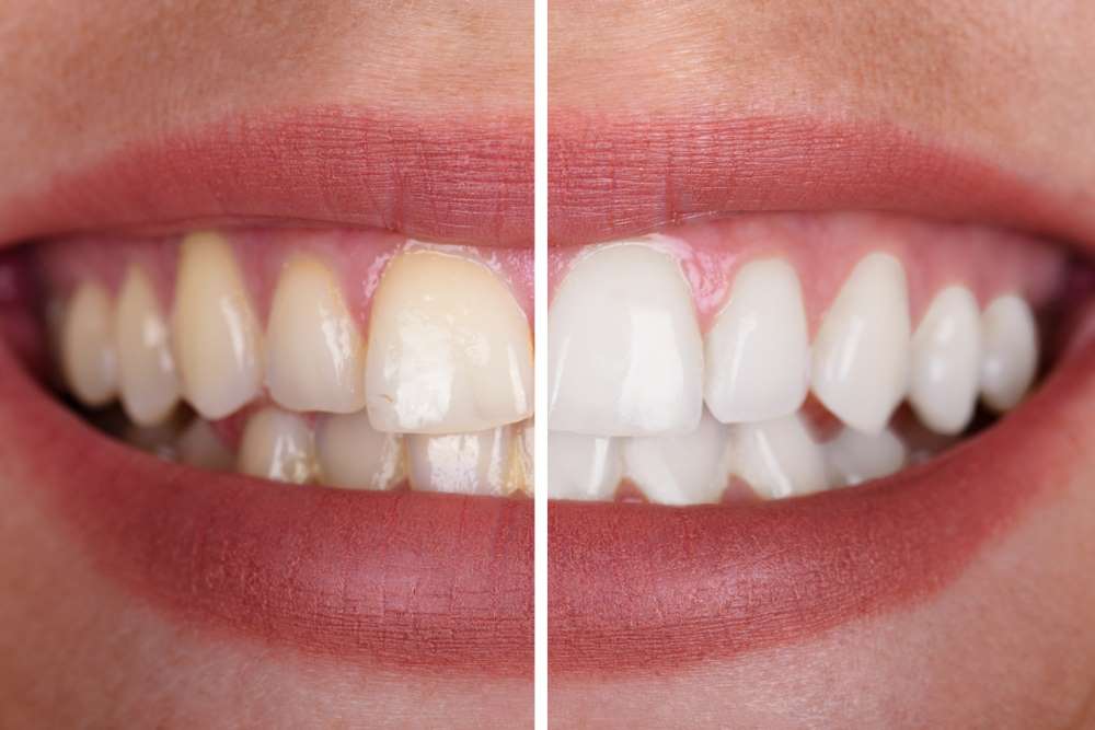 Weiße Zähne Bleaching – Zahnarztpraxis Dr. Waas München